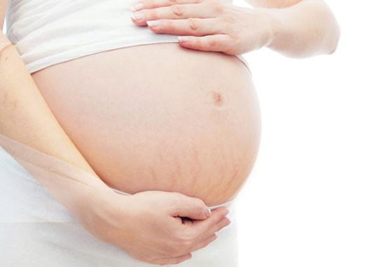 Tudo que você precisa saber sobre estrias na gravidez